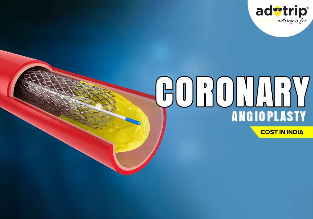 Coronary Angioplasty Cost in India